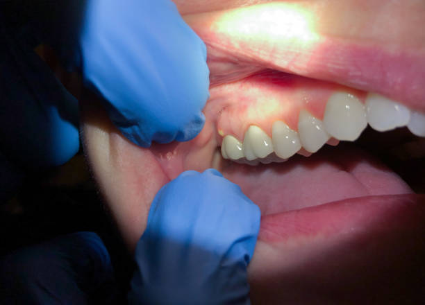 Best Emergency Dental Care for Broken or Chipped Teeth in Eddyville, KY