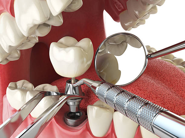 Best Urgent Care for Lost Fillings or Crowns in Eddyville, KY